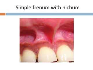 Simple frenum with nichum
 