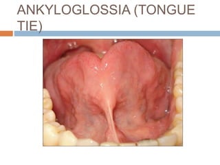 ANKYLOGLOSSIA (TONGUE
TIE)
 