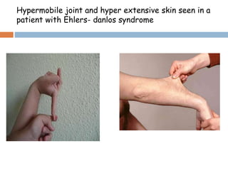Hypermobile joint and hyper extensive skin seen in a
patient with Ehlers- danlos syndrome
 