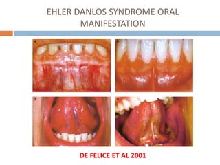 EHLER DANLOS SYNDROME ORAL
MANIFESTATION
DE FELICE ET AL 2001
 
