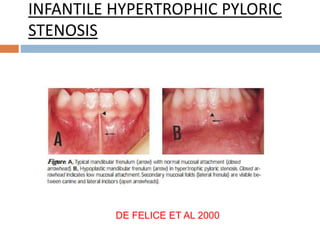 INFANTILE HYPERTROPHIC PYLORIC
STENOSIS
DE FELICE ET AL 2000
 