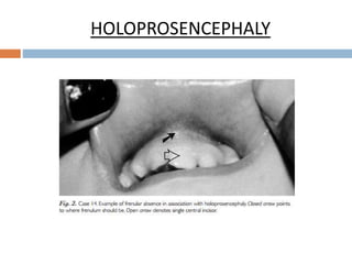 HOLOPROSENCEPHALY
 