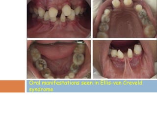 Oral manifestations seen in Ellis-van Creveld
syndrome
 
