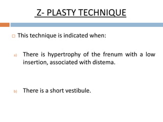 Z- PLASTY TECHNIQUE
 This technique is indicated when:
a) There is hypertrophy of the frenum with a low
insertion, associated with distema.
b) There is a short vestibule.
 