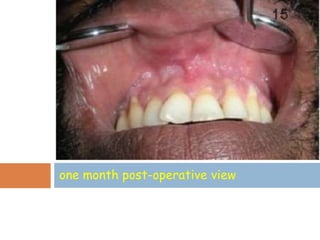 one month post-operative view
 