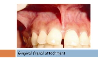 Gingival frenal attachment
 