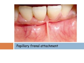 Papillary frenal attachment
 