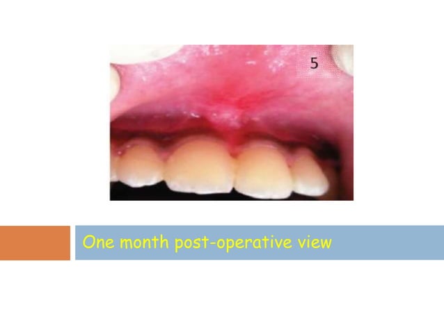 Frenum attachment and it's management.
