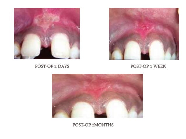 Frenum attachment and it's management.