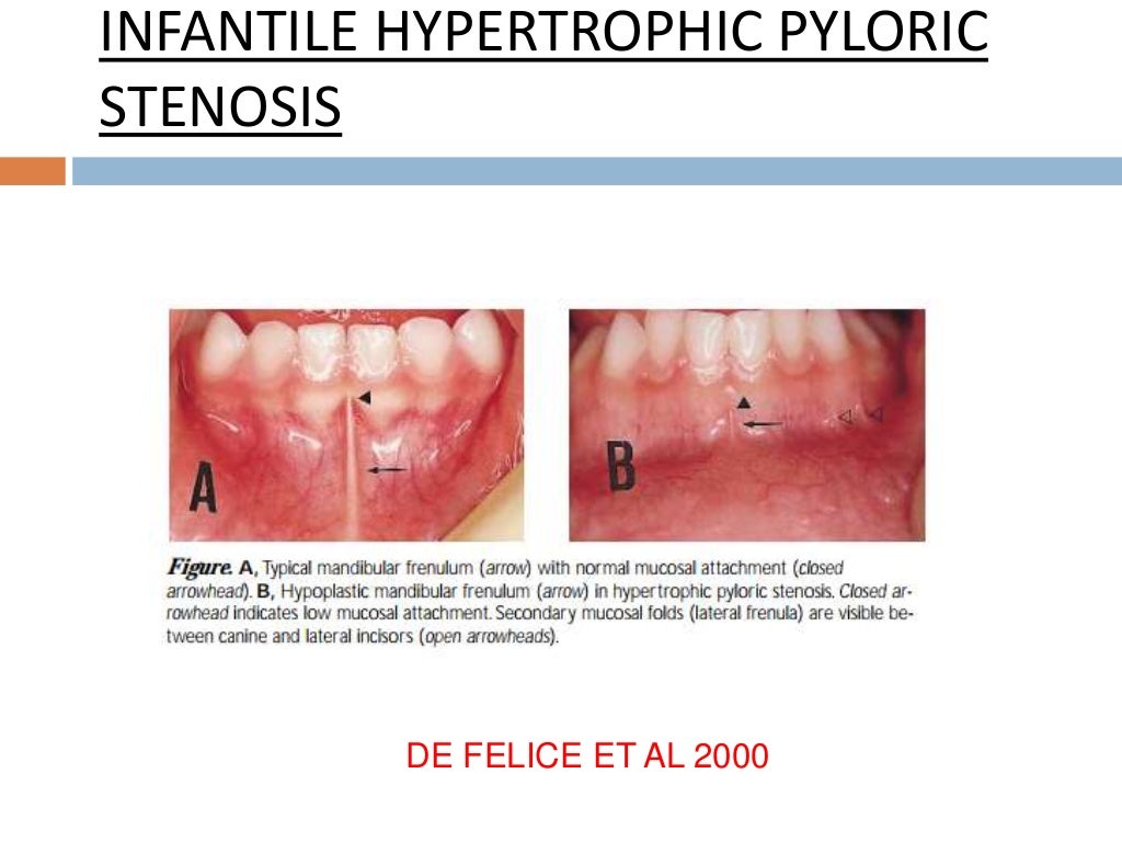 Frenum attachment and it's management.