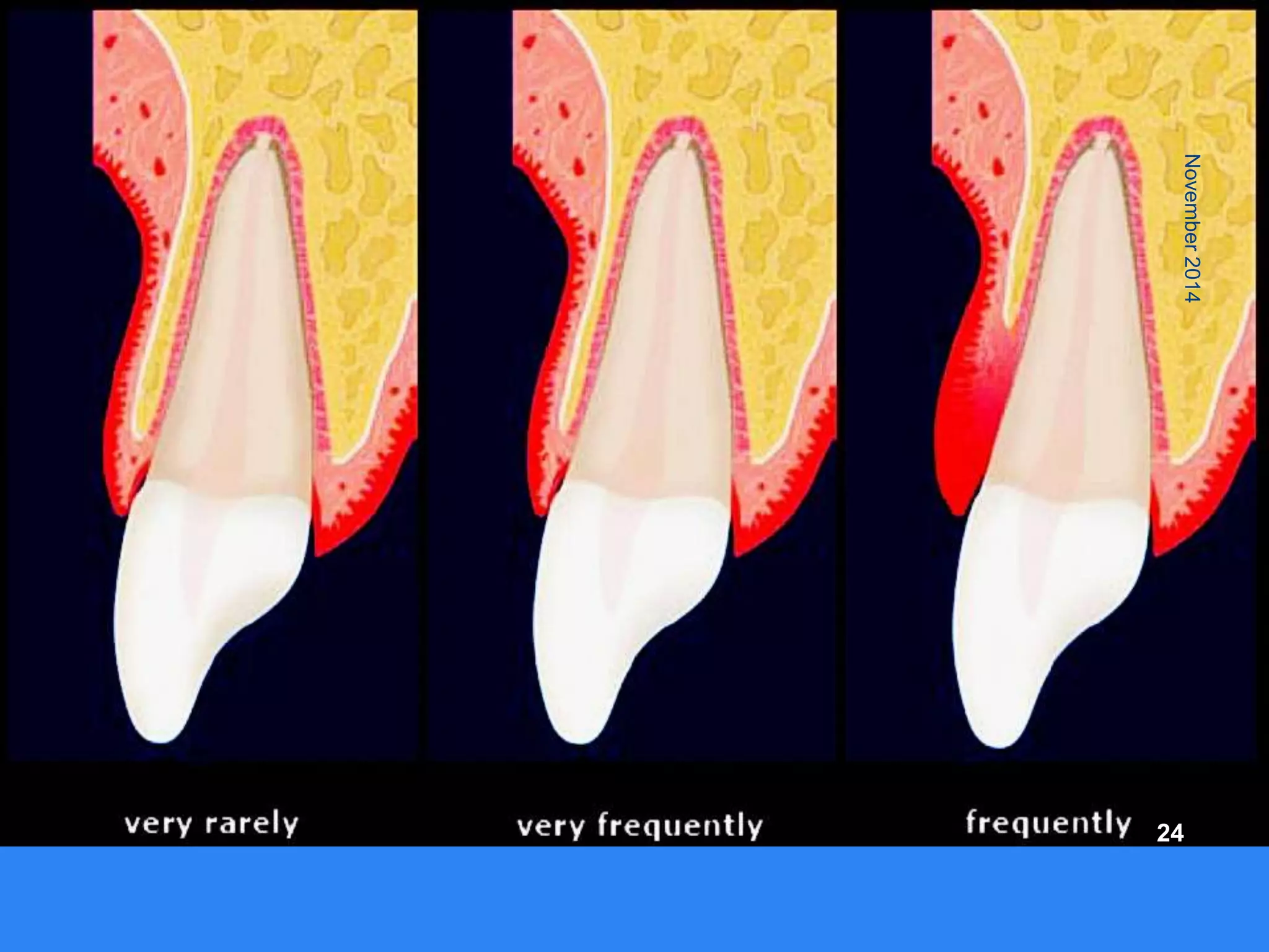 Fresh socket implant placement | PPTX