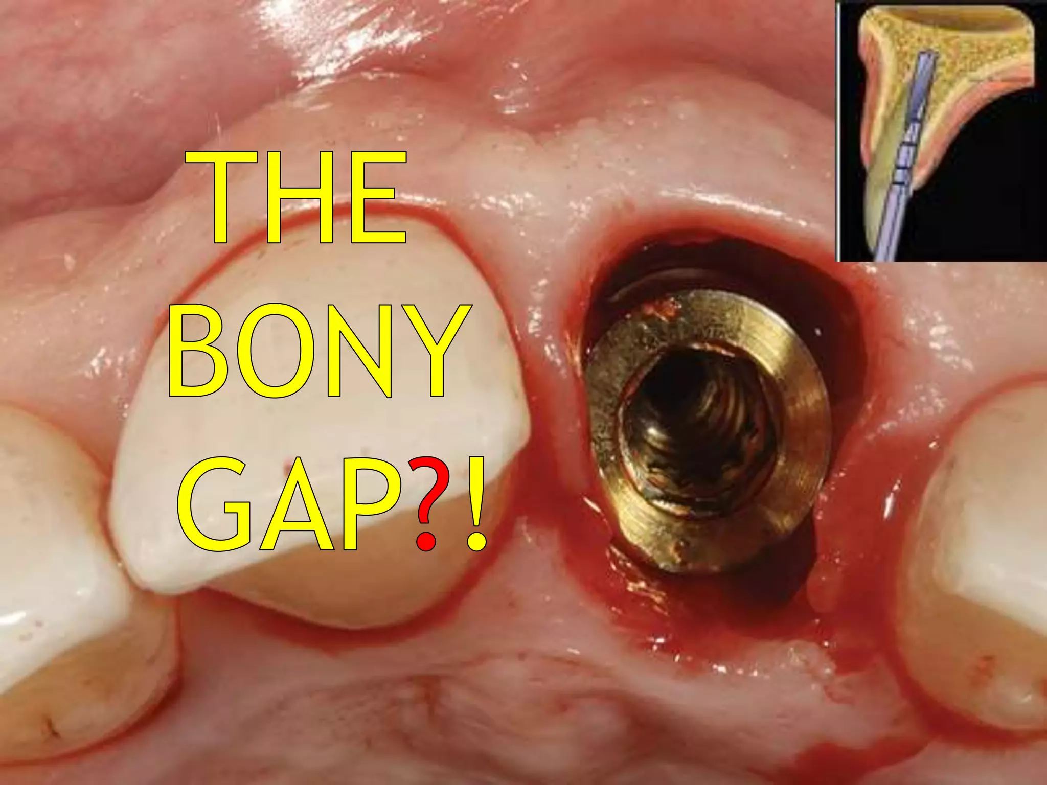 Fresh socket implant placement | PPTX