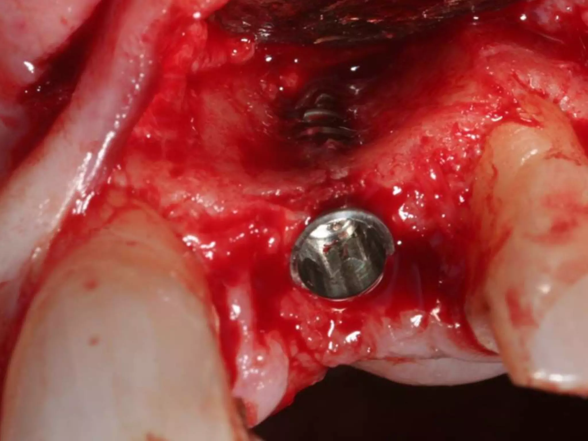 Fresh socket implant placement | PPTX