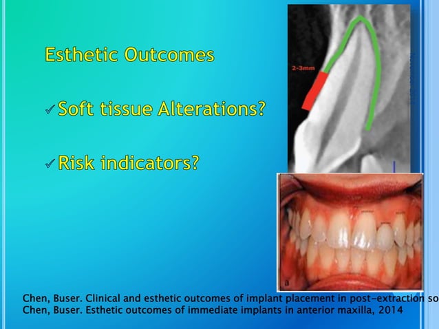 Fresh socket implant placement | PPTX