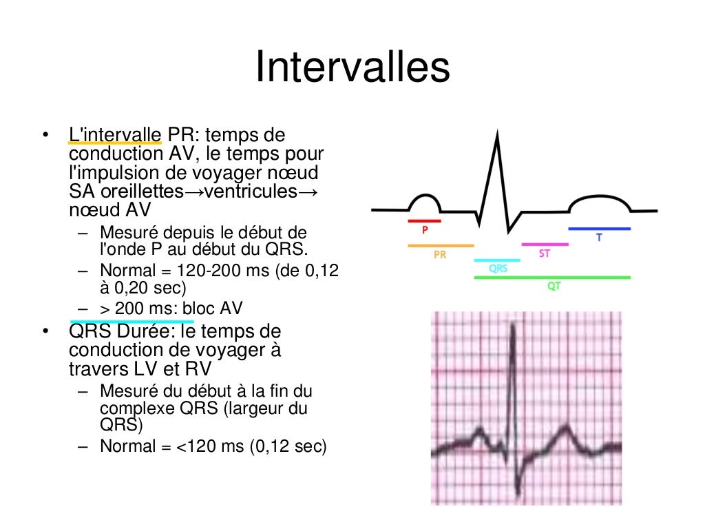 Base ECG et l'interprétation du rythme (French) Symposia