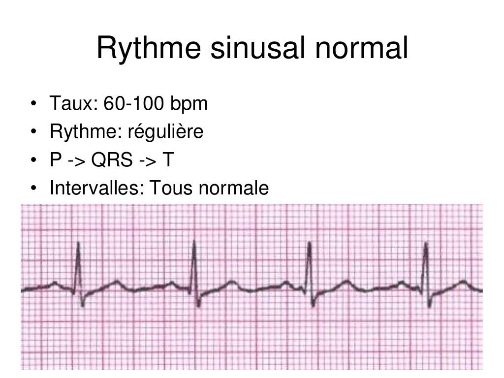 Base ECG et l'interprétation du rythme (French) Symposia