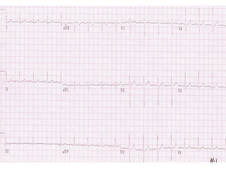 Base ECG et l'interprétation du rythme (French) Symposia