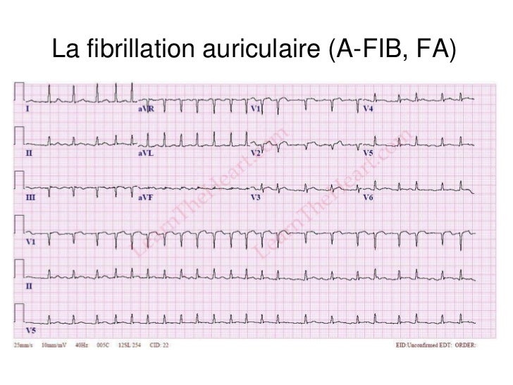 Base ECG et l'interprétation du rythme (French) Symposia