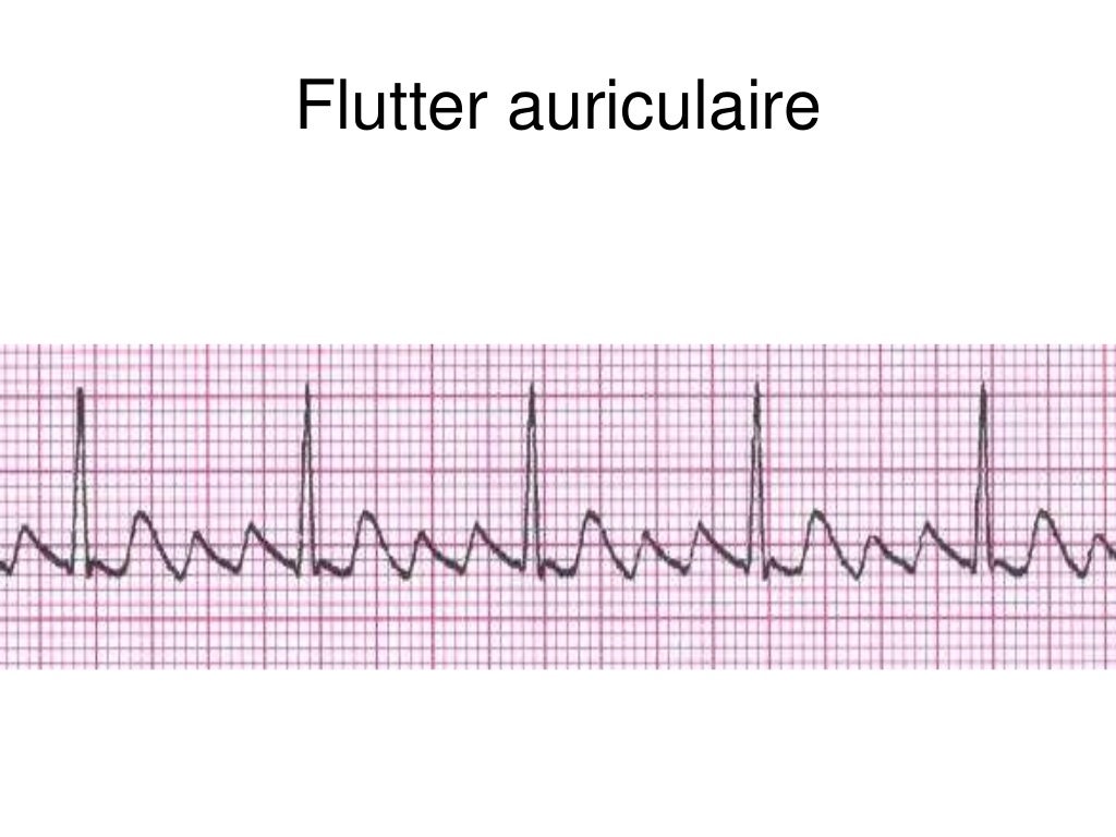 Base ECG et l'interprétation du rythme (French) Symposia