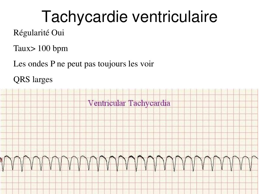 Base ECG et l'interprétation du rythme (French) Symposia