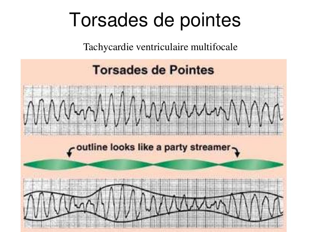 Base ECG et l'interprétation du rythme (French) Symposia