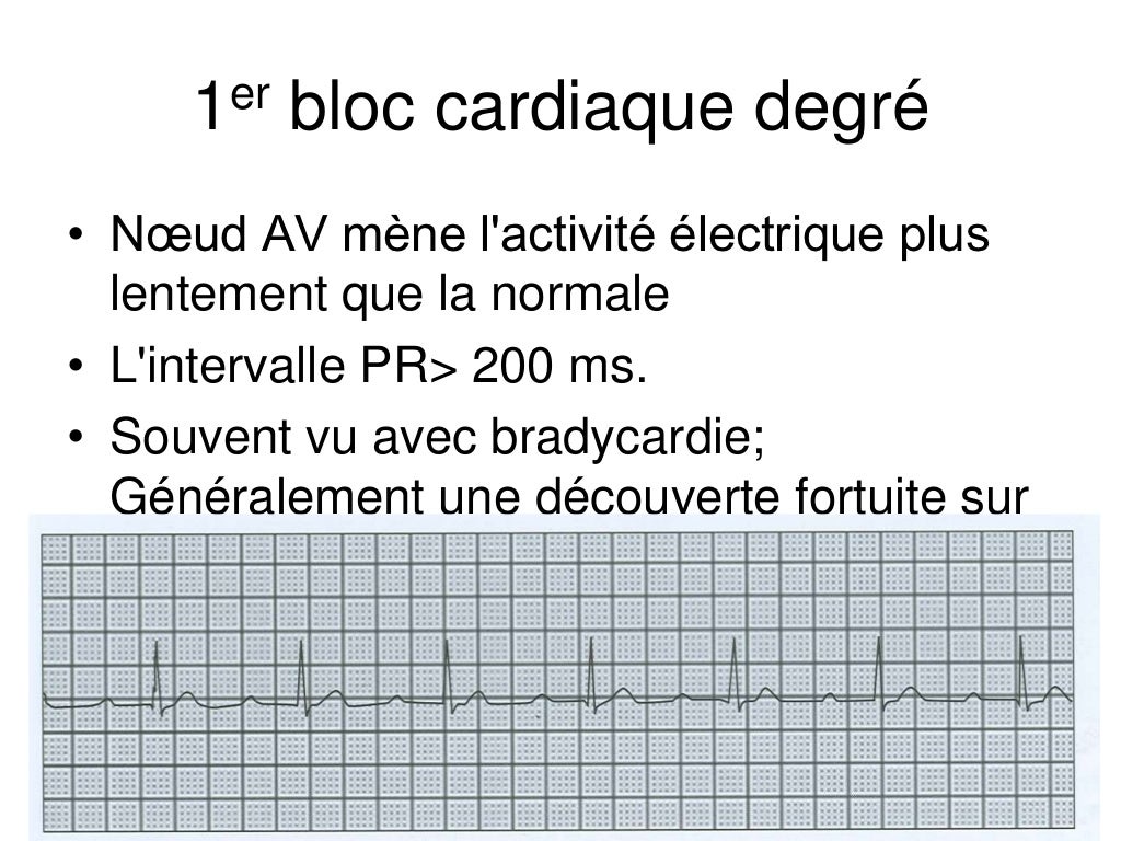 Base ECG et l'interprétation du rythme (French) Symposia