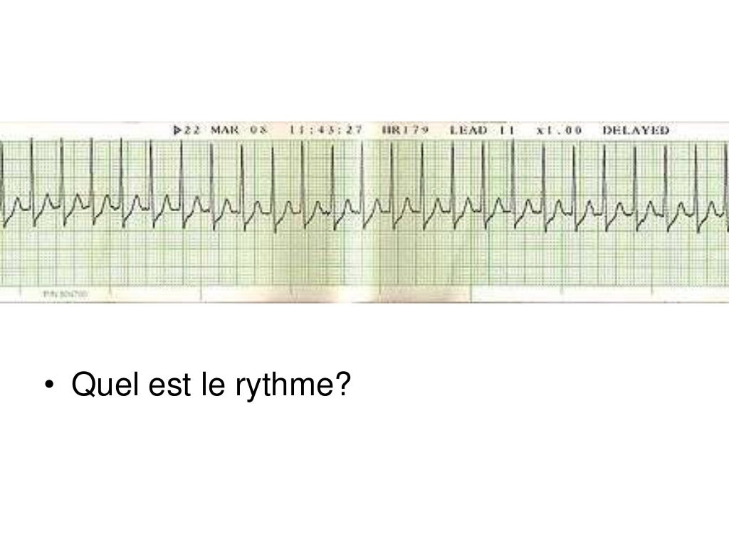 Base ECG et l'interprétation du rythme (French) Symposia