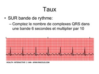 Taux
• SUR bande de rythme:
  – Comptez le nombre de complexes QRS dans
    une bande 6 secondes et multiplier par 10
 