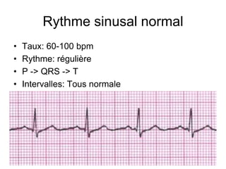 Rythme sinusal normal
•   Taux: 60-100 bpm
•   Rythme: régulière
•   P -> QRS -> T
•   Intervalles: Tous normale
 
