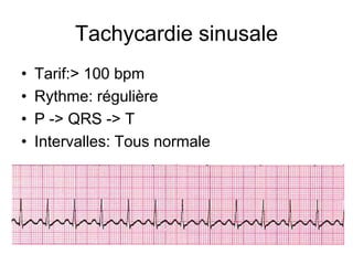 Tachycardie sinusale
•   Tarif:> 100 bpm
•   Rythme: régulière
•   P -> QRS -> T
•   Intervalles: Tous normale
 