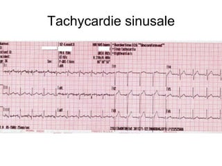 Tachycardie sinusale
 