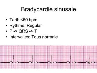 Bradycardie sinusale
•   Tarif: <60 bpm
•   Rythme: Regular
•   P -> QRS -> T
•   Intervalles: Tous normale
 