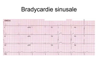 Bradycardie sinusale
 