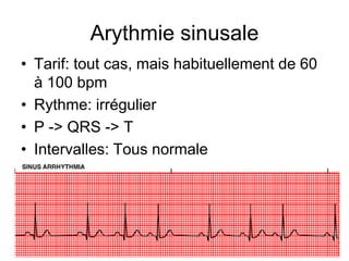 Arythmie sinusale
• Tarif: tout cas, mais habituellement de 60
  à 100 bpm
• Rythme: irrégulier
• P -> QRS -> T
• Intervalles: Tous normale
 