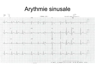 Arythmie sinusale
 