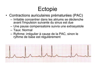 Ectopie
• Contractions auriculaires prématurées (PAC)
  – Irritable concentrer dans les atriums se déclenche
    avant l'impulsion suivante du sinus est due
  – Une pause compensatoire suivra une extrasystole
  – Taux: Normal
  – Rythme: irrégulier à cause de la PAC, sinon le
    rythme de base est régulièrement
 