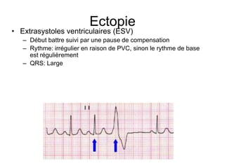 Ectopie
• Extrasystoles ventriculaires (ESV)
   – Début battre suivi par une pause de compensation
   – Rythme: irrégulier en raison de PVC, sinon le rythme de base
     est régulièrement
   – QRS: Large
 