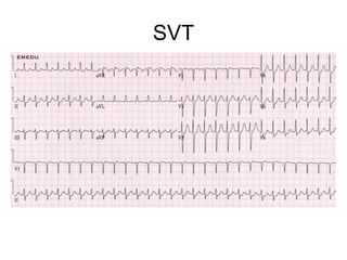 SVT
 
