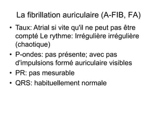 La fibrillation auriculaire (A-FIB, FA)
• Taux: Atrial si vite qu'il ne peut pas être
  compté Le rythme: Irrégulière irrégulière
  (chaotique)
• P-ondes: pas présente; avec pas
  d'impulsions formé auriculaire visibles
• PR: pas mesurable
• QRS: habituellement normale
 