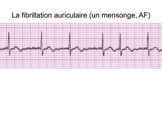 La fibrillation auriculaire (un mensonge, AF)
 