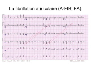 La fibrillation auriculaire (A-FIB, FA)
 