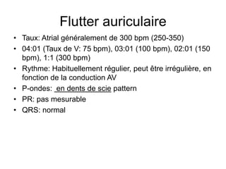 Flutter auriculaire
• Taux: Atrial généralement de 300 bpm (250-350)
• 04:01 (Taux de V: 75 bpm), 03:01 (100 bpm), 02:01 (150
  bpm), 1:1 (300 bpm)
• Rythme: Habituellement régulier, peut être irrégulière, en
  fonction de la conduction AV
• P-ondes: en dents de scie pattern
• PR: pas mesurable
• QRS: normal
 