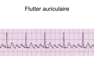 Flutter auriculaire
 