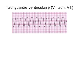 Tachycardie ventriculaire (V Tach, VT)
 