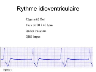 Rythme idioventriculaire
   Régularité Oui
   Taux de 20 à 40 bpm
   Ondes P aucune
   QRS larges
 