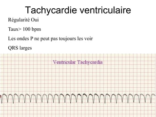 Tachycardie ventriculaire
Régularité Oui
Taux> 100 bpm
Les ondes P ne peut pas toujours les voir
QRS larges
 