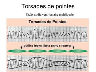 Torsades de pointes
 Tachycardie ventriculaire multifocale
 
