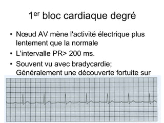 1er bloc cardiaque degré
• Nœud AV mène l'activité électrique plus
  lentement que la normale
• L'intervalle PR> 200 ms.
• Souvent vu avec bradycardie;
  Généralement une découverte fortuite sur
  une routine ECG
 