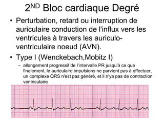 2ND Bloc cardiaque Degré
• Perturbation, retard ou interruption de
  auriculaire conduction de l'influx vers les
  ventricules à travers les auriculo-
  ventriculaire noeud (AVN).
• Type I (Wenckebach,Mobitz I)
  – allongement progressif de l'intervalle PR jusqu'à ce que
    finalement, le auriculaire impulsions ne parvient pas à effectuer,
    un complexe QRS n'est pas généré, et il n'ya pas de contraction
    ventriculaire
 