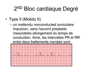 2ND Bloc cardiaque Degré
• Type II (Mobitz II)
  – un inattendu nonconducted auriculaire
    impulsion, sans l'accord préalable
    mesurables allongement du temps de
    conduction. Ainsi, les intervalles PR et RR
    entre deux battements menées sont
    constants.
 